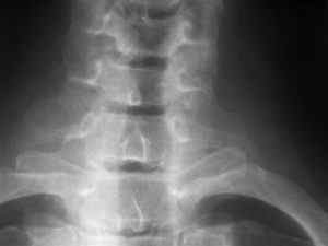 Синдром Кліппеля-Фейля: фото, симптоми і лікування, ознаки на рентгенограмах | Ревматолог