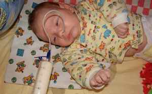 Синдром короткої кишки у дітей: лікування та прогноз для життя