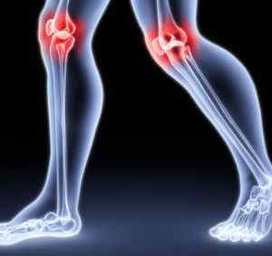 Синдром медіопателлярной складки колінного суглоба: Шелф синдром, симптоми і лікування, діагностика | Ревматолог
