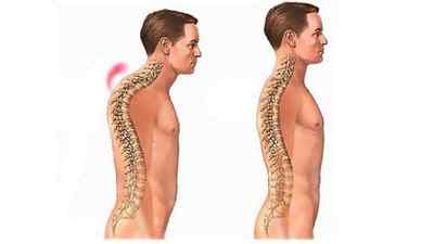 Синдром Шейермана Мау: лікування хвороби і викривлення хребта, значення сутулою спини | Ревматолог