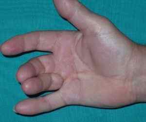 Синдром Зудека: симптоми і лікування після перелому променевої кістки руки, фото і стадії розвитку, ускладнення і наслідки | Ревматолог