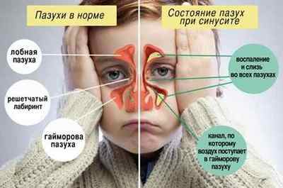 Синусит у дитини - перші симптоми і лікування захворювання
