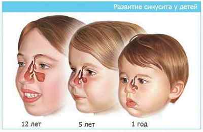 Синусит у дитини - перші симптоми і лікування захворювання