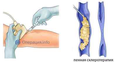 Склеротерапія /склерозування вен нижніх кінцівок (ніг)