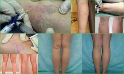 Склеротерапія вен нижніх кінцівок: відгуки, фото до і після, ціна