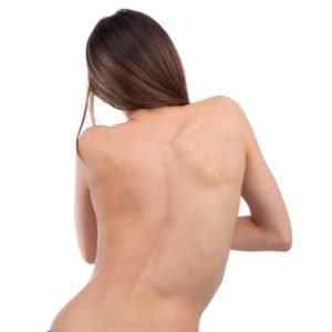 Сколіоз грудного відділу хребта: правобічний і лівобічний, вправи при викривленні грудної клітини, симптоми і лікування | Ревматолог