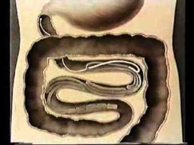 Солітер червяк в організмі: що це таке, ознаки та фото, симптоми