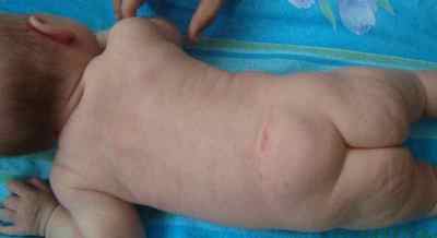 Спина біфідо (розщеплення хребта) у новонароджених: причини і лікування, рентген | Ревматолог