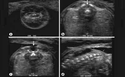 Спина біфідо (розщеплення хребта) у новонароджених: причини і лікування, рентген | Ревматолог