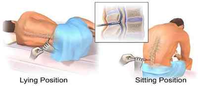 Спинальная анестезія (спинномозкова): застосування, проведення, наслідки