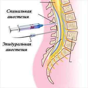 Спинномозкова анестезія (спинальний наркоз): наслідки після операції і ускладнення | Ревматолог