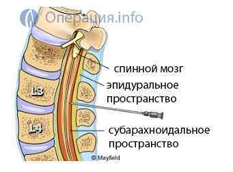 Спинномозкова пункція (спинного мозку): показання, проведення, результати