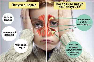 Список хвороб носа з характерними для них симптомами