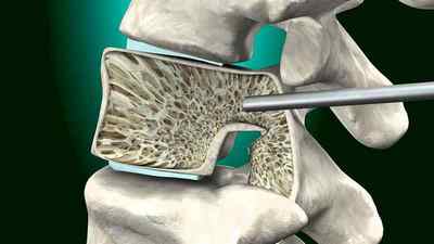 Спондилодез: що це таке, передній і задній, міжтіловий і транспедикулярного, шийного і поперекового відділу хребта | Ревматолог