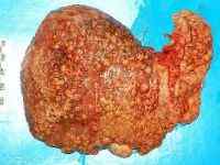 Стадії цирозу печінки: причини, класифікація ступенів