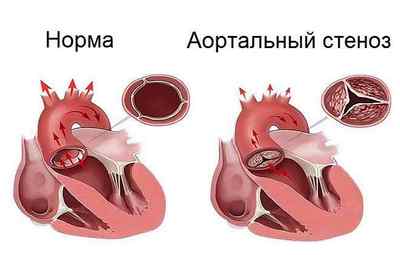 Стеноз аортального клапана і лікування без операції