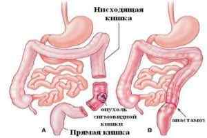 Стеноз кишечника: симптоми і лікування (хірургія, харчування, препарати)