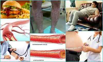 Стенозуючий атеросклероз артерій нижніх кінцівок: причини, ознаки, діагностика, лікування