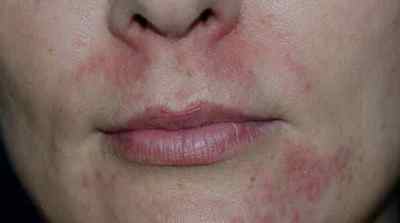 Стероїдний дерматит на обличчі: що таке, як вилікувати?