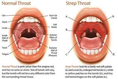 Стрептококова інфекція: лікування стрептокока в горлі