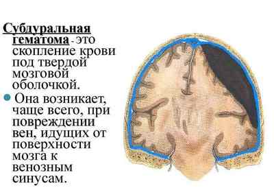 Субдуральна гематома головного мозку, лікування хронічної форми, наслідки після операції