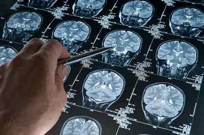 Субдуральна гематома головного мозку, лікування хронічної форми, наслідки після операції