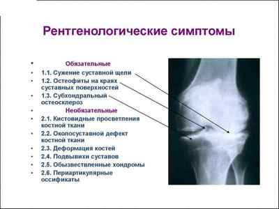 Субхондральний склероз суглобових поверхонь: що це таке, остеосклероз, лікування хребта | Ревматолог