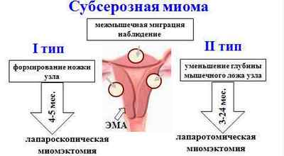 Субсерозна міома матки: фото, симптоми, лікування