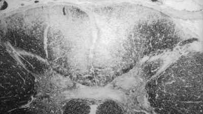 Сухотка спинного мозку: що це таке, симптоми і лікування | Ревматолог