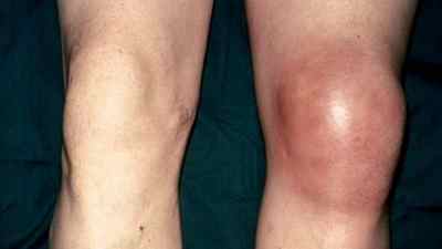 Супрапателлярний бурсит колінного суглоба: що це таке, симптоми і лікування народними засобами | Ревматолог