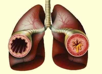 Свист в легенях при диханні у дітей і дорослих: причини, лікування