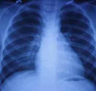 Свист в легенях при диханні у дітей і дорослих: причини, лікування
