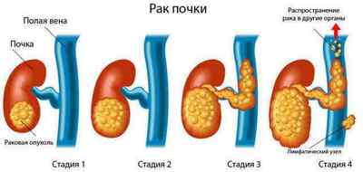 Світлоклітинний і нирково клітинний рак нирки