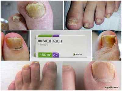 Таблетки Флуконазол від грибка нігтів на ногах: інструкція із застосування, ціна, відгуки, аналоги