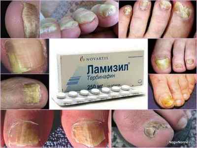 Таблетки ламізил від грибка нігтів: інструкція із застосування, ціна, відгуки, аналоги