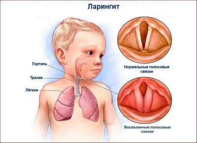 Температура, кашель і нежить у дитини: причини, лікування