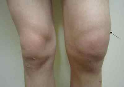 Тендиніт колінного суглоба: симптоми і лікування запалень сухожиль, причини, лікування в домашніх умовах народними засобами | Ревматолог