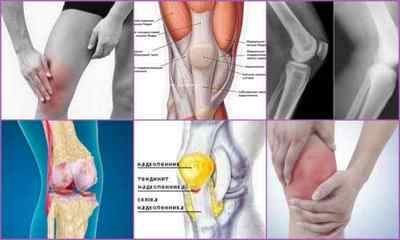 Тендиніт колінного суглоба - симптоми і лікування запалення сухожиль коліна