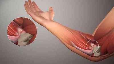 Тендиніт плечового суглоба: симптоми і лікування народними засобами, КАЛЬЦИНУЮЧА тендиніт, запалення мяза плеча | Ревматолог