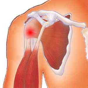 Тендиніт плечового суглоба: симптоми і лікування народними засобами, КАЛЬЦИНУЮЧА тендиніт, запалення мяза плеча | Ревматолог
