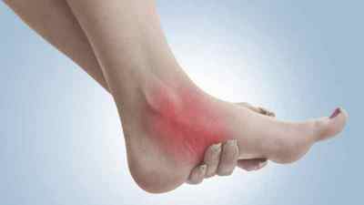 Тендиніт (запалення) стопи ноги: симптоми і лікування, Перонеальная тендиніт ступні і мазі | Ревматолог