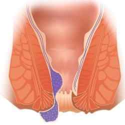 Тенезми кишечника: причини і лікування патології