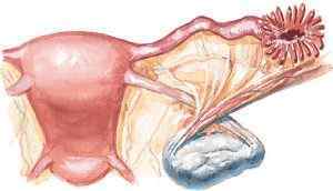 Тератома яєчника: види, причини, симптоми і лікування