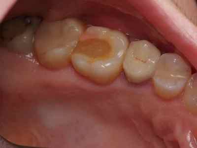 Алергія на зубну пломбу