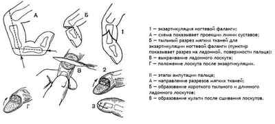 Ампутація пальця ноги і руки (стопи і кисті), фаланг