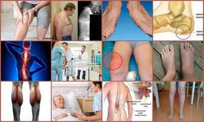 Апарат Дельта для лікування суглобів: відгуки, застосування