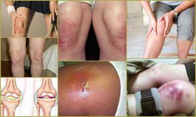 Артрит колінного суглоба: симптоми, лікування, діагностика, фото, причини