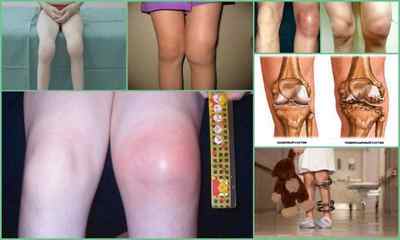 Артрит колінного суглоба у дітей: причини, симптоми, лікування