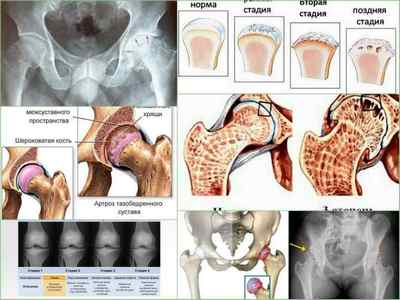Артрит тазостегнового суглоба: симптоми, лікування, причини, діагностика, фото