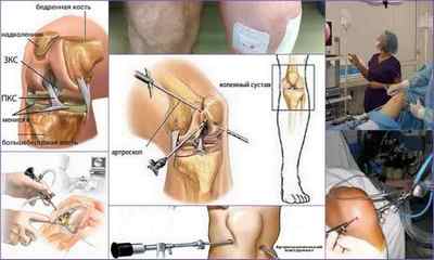 Артроскопія колінного, тазостегнового, гомілковостопного суглобів: що це таке, як проводиться діагностика і операція, ціна, протипоказання, реабілітація, відгуки